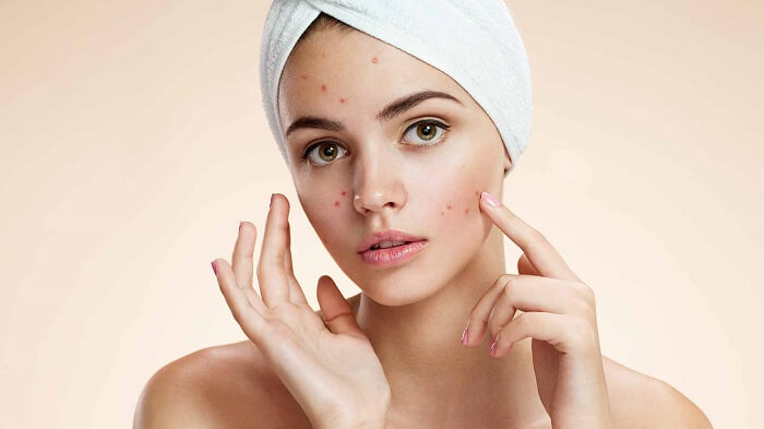 how-to-remove-acne